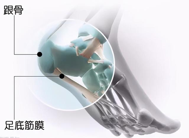 足底疼痛位置图，脚底疼痛部位图解（足跟痛是什么？要怎样预防）