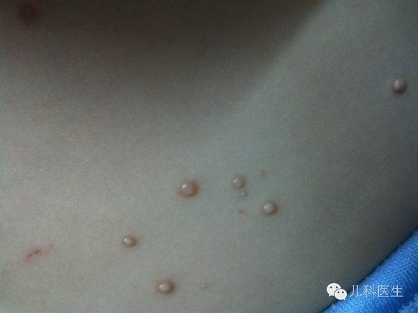 传染性软疣(molluscum contagiosum)又名皮脂性软疣,传染性上皮瘤,上