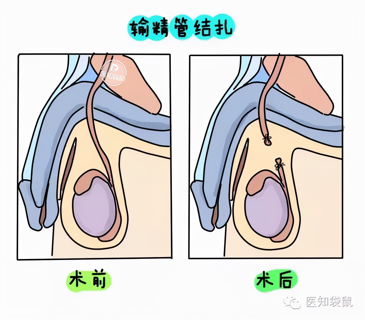 对于男性,接受的输精管绝育术,并不会伤及睾丸,不会影响雄激素的分泌