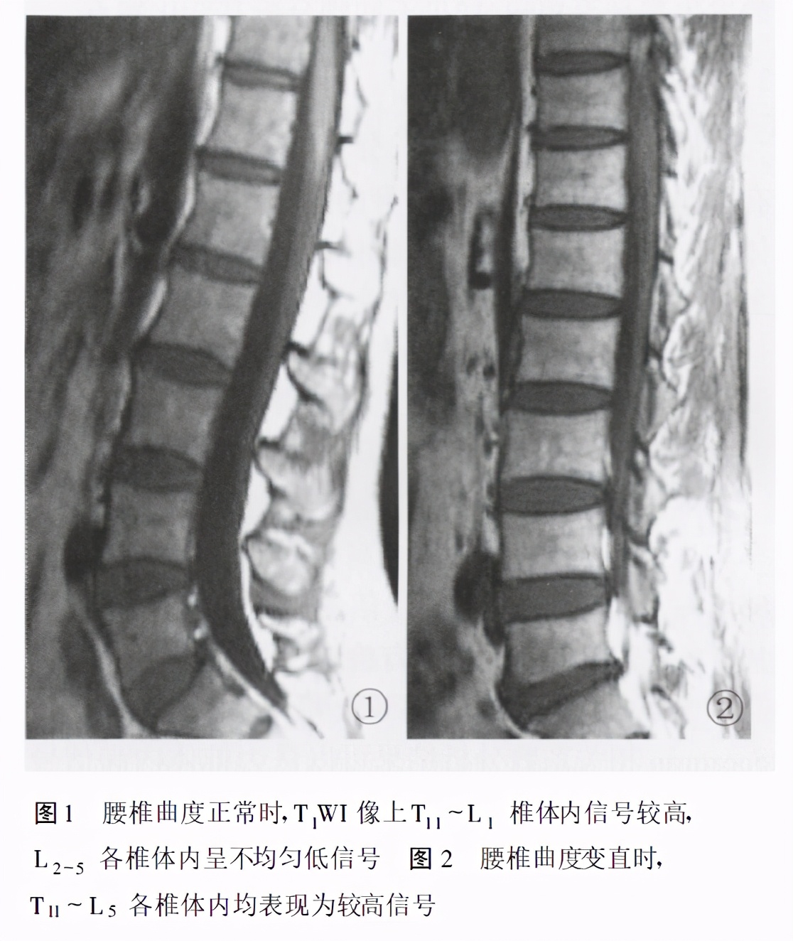 腰椎曲度变直腰椎曲度变直如何矫正最有效方法