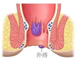 痔疮一期二期三期图片痔疮有3型4期快来对照下