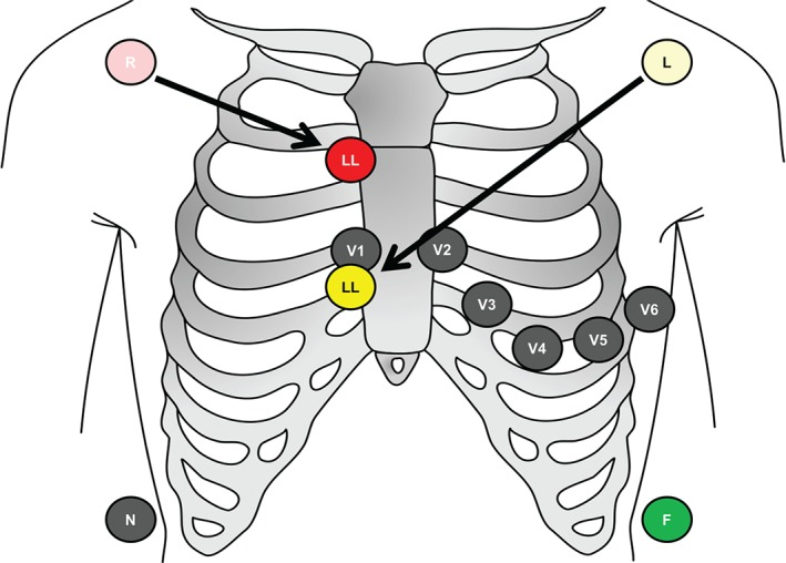 18导联心电图位置顺序18导联心电图位置顺序示意图