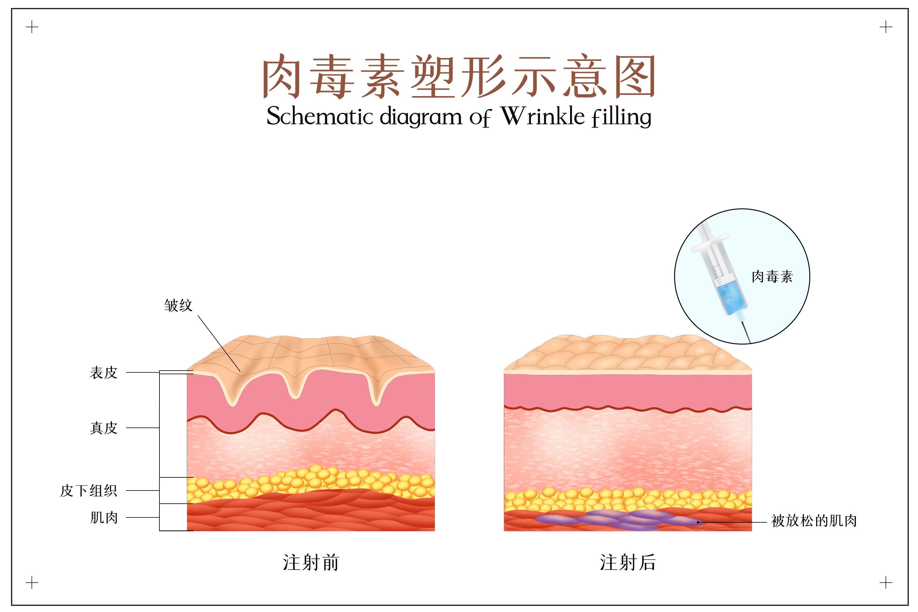 玻尿酸、自體脂肪、肉毒素，哪種除皺效果更好？