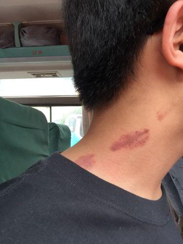 如何种草莓吻痕技巧(如何种草莓吻痕要吸多久)-寅森速头条