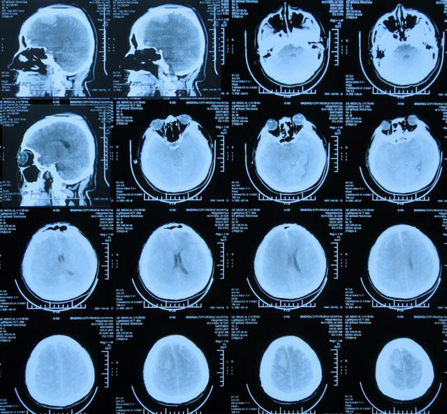 顱腦外傷雙側開顱去骨瓣減壓術後硬膜下積液腦積水腰大池腹腔分流術後