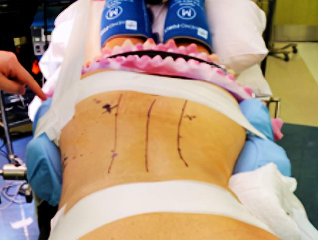 俯卧位llif手术cadaver可行性研究及早期临床