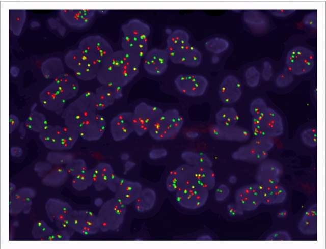 85),并通过荧光原位杂交(fish)进行了确认.