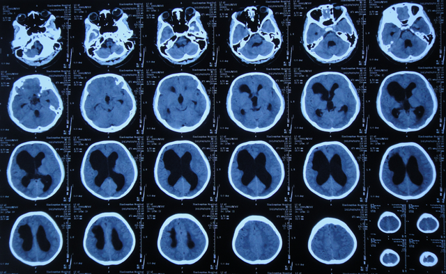 腦積水15年後發作頭脹嘔吐但外院腦室腹腔分流術後仍腦積水且腦室穿刺