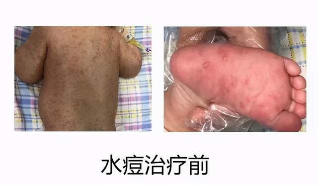 湘潭县妇幼保健院新生儿科助新生宝宝成功战“痘”