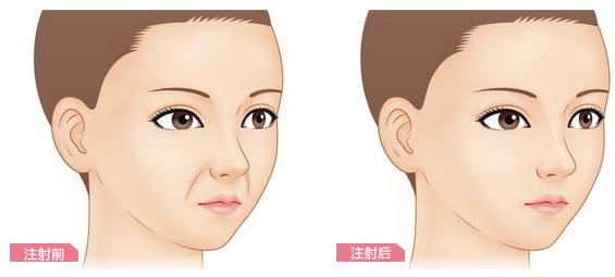 自体脂肪填充鼻唇沟赶走法令纹年轻不是梦 抽脂失败修复