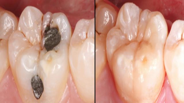 牙有个大窟窿疼怎么办