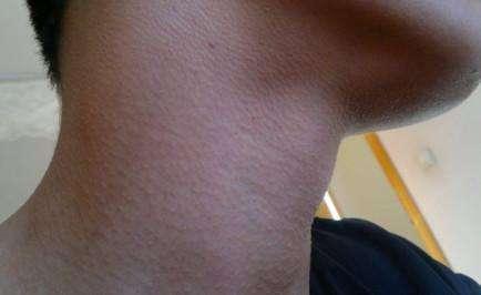 腿部如何去鸡皮疙瘩