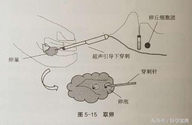 什么叫“试管婴儿”？试管婴儿治疗的条件和流程