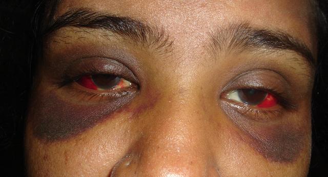 熊猫眼征"要注意什么?