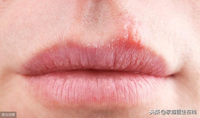 嘴角起泡应该怎么处理？按照这样做，很快就能消除