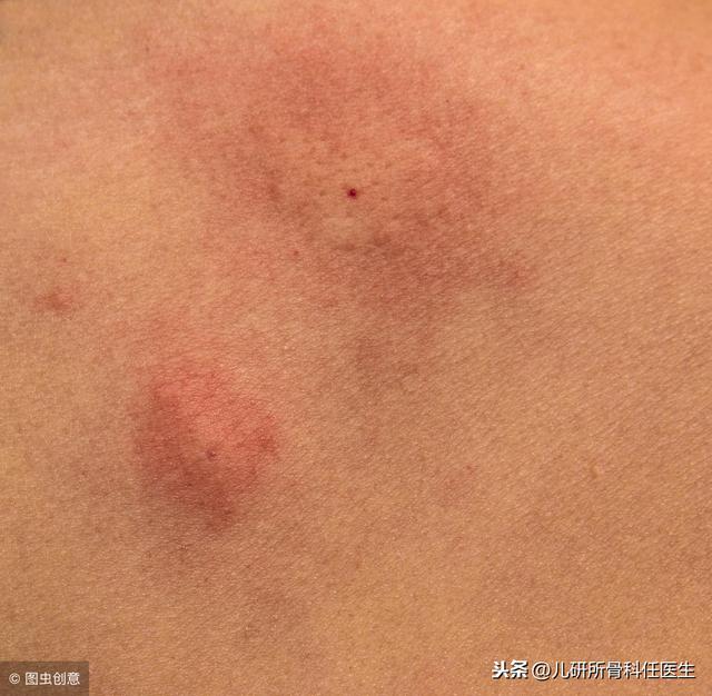 宝宝被蚊虫叮咬，爸爸妈妈莫惊慌，儿科医生告诉你如何处理