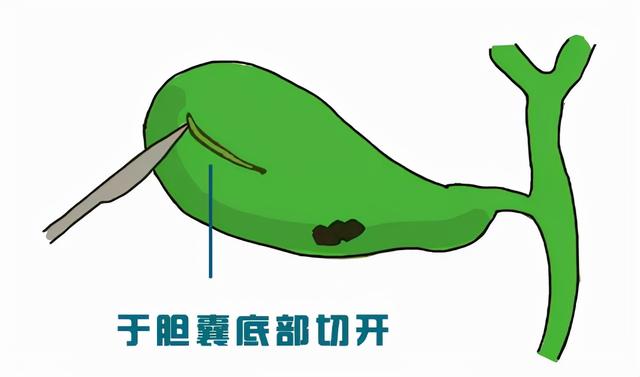 “冬季到，胆结石闹”那么治疗胆结石到底是切还是保？
