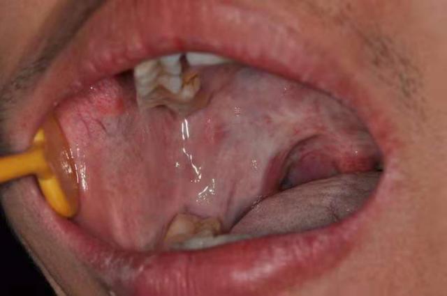 男子每天都吃这种 养生零食 一年后差点得癌 全网搜