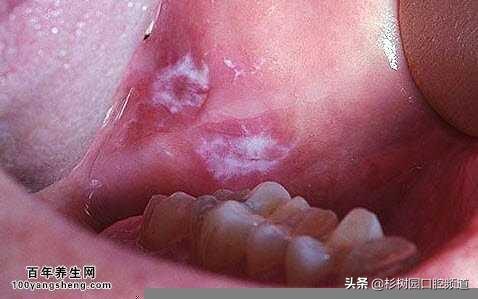口腔溃疡白色角化