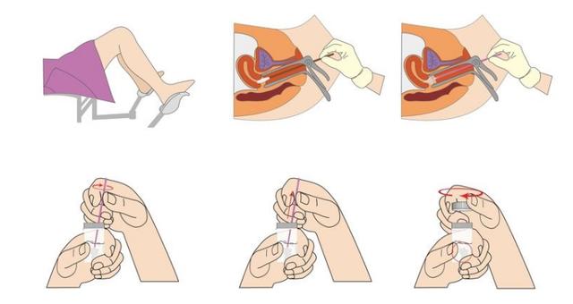 tct是什么妇科检查(tct是什么妇科检查多少钱) - 天星聚