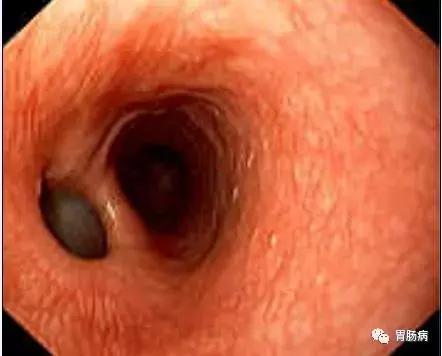 食管癌鳞癌角化型