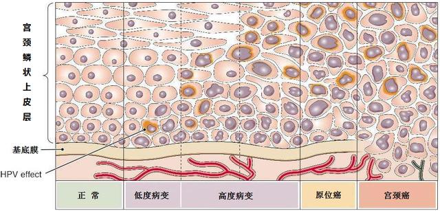 tct细胞学检查结果异常是什么意思