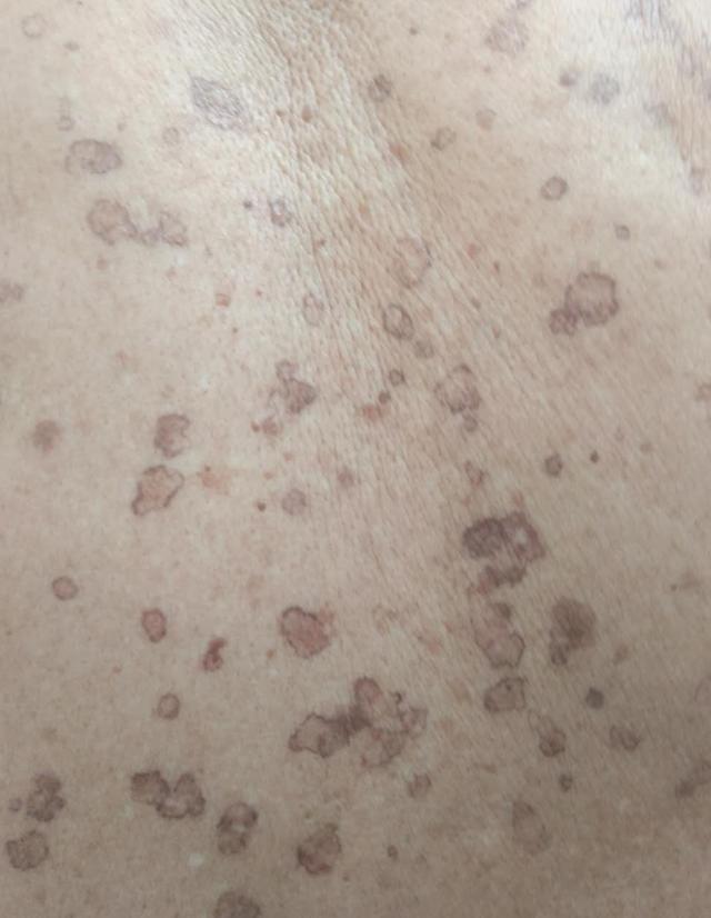 尿素霜治汗孔角化症吗