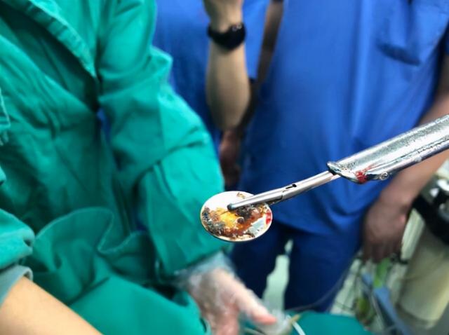 3岁男童误吞纽扣电池灼穿小肠，取出时竟成金属疙瘩，有多可怕？