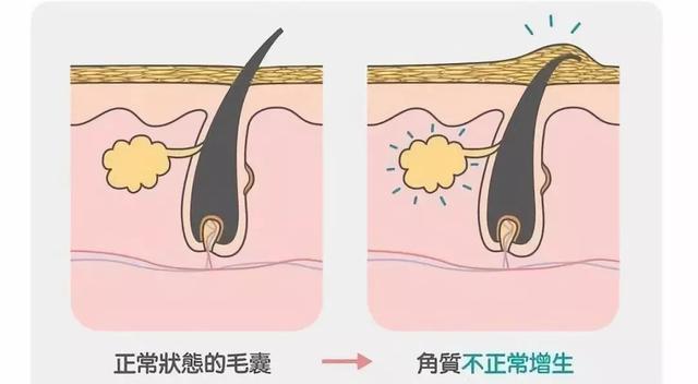 鸡皮肤只有女生有吗