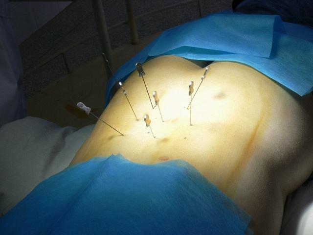 中老年人腰间盘突出，前中期预防和治疗很关键，后期多是手术