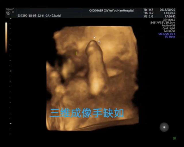 你也能看懂的胎儿畸形——病例分享