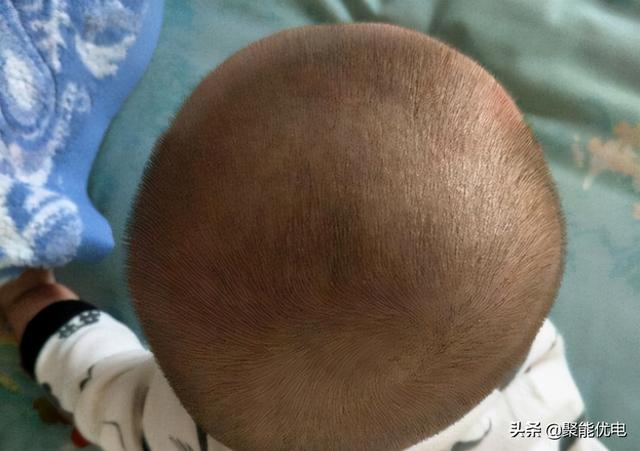 容貌焦虑会传染！宝妈给扁头宝宝戴石膏头模