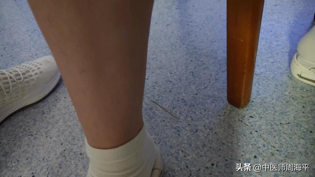 针灸医案分享3（同事的急性胃肠炎）