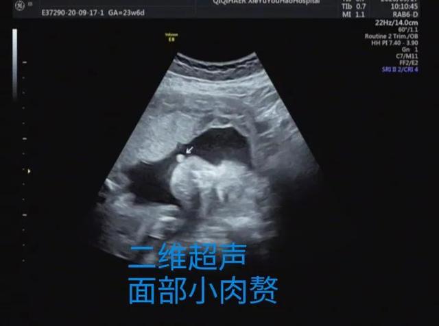 你也能看懂的胎儿畸形——病例分享
