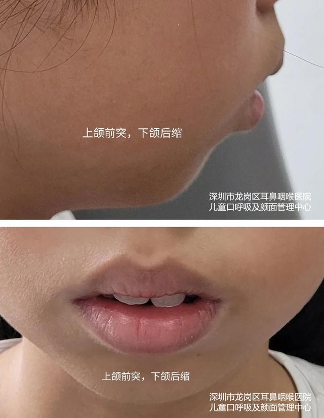 张口呼吸会长歪，用“闭嘴贴”？医生：胡来！