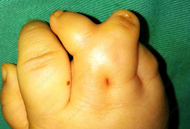 手外周海定宝宝并指术后出现手指倾斜，需要二次手术吗？