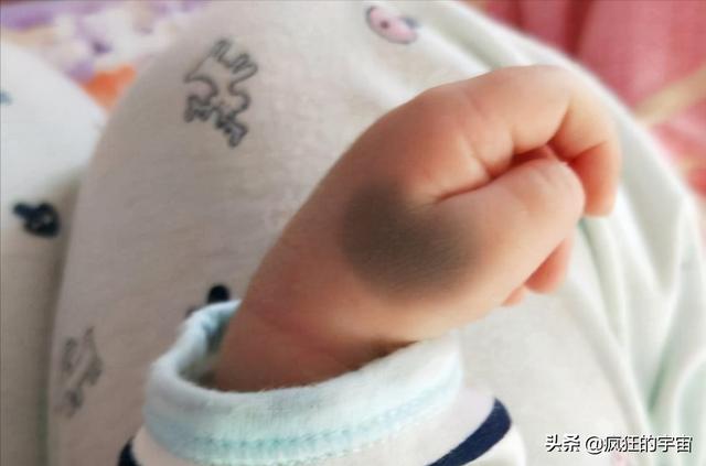 为啥很多刚出生的婴儿屁股上都有“淤青“？答案终于来了