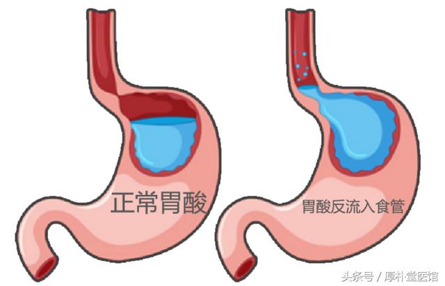 反流性食管炎怎么办