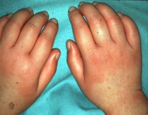 六大症状 三大注意 辨识川崎病有窍门_健康症状网