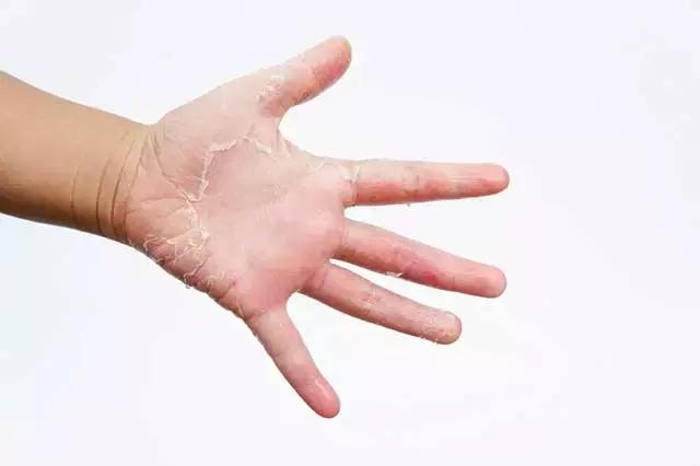 湿疹和鸡皮疙瘩痒