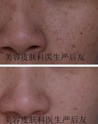 脸颊毛细血管扩张和毛周角化