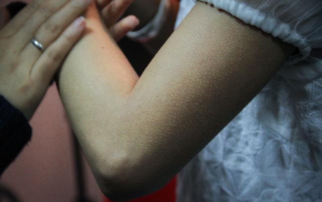 一说恐惧事物就起鸡皮疙瘩