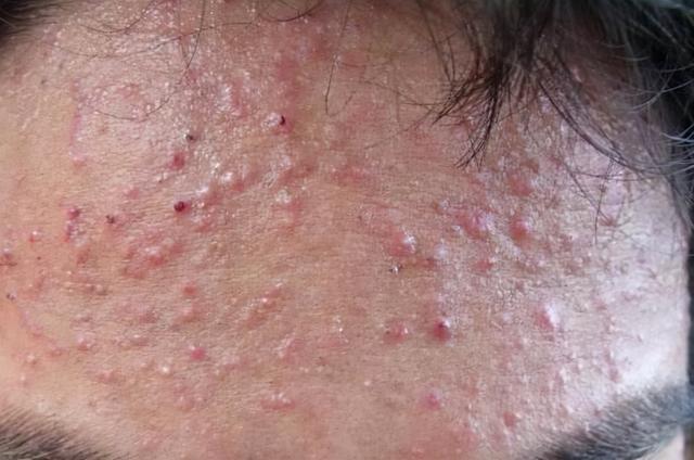 治疗毛周角化症有偏偏方