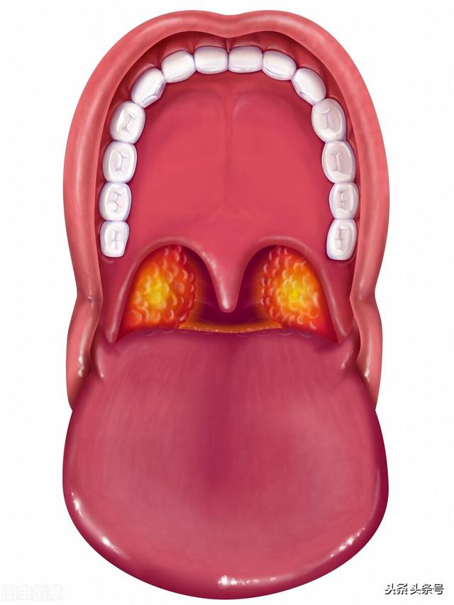 急性化脓性扁桃体炎·经方辨证