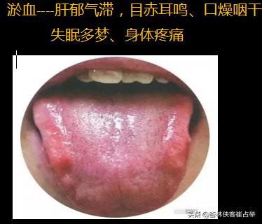 肺气虚、心阴虚、脾气虚，动一动就出汗怎么办？中医：治汗六法