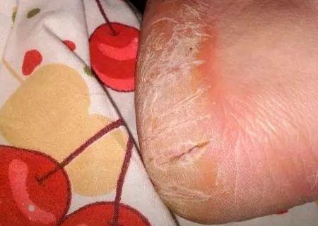 小腿表面粗糙似鱼鳞状