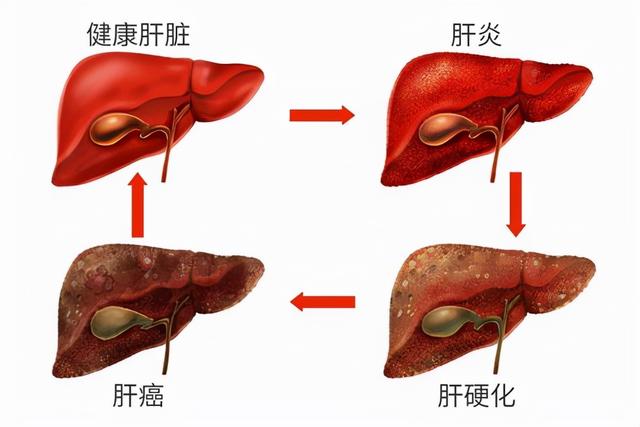 肝不好要多吃素？医生：若想养肝，4种“素食”尽量少吃