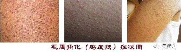 小腿太干鸡皮疙瘩红痒