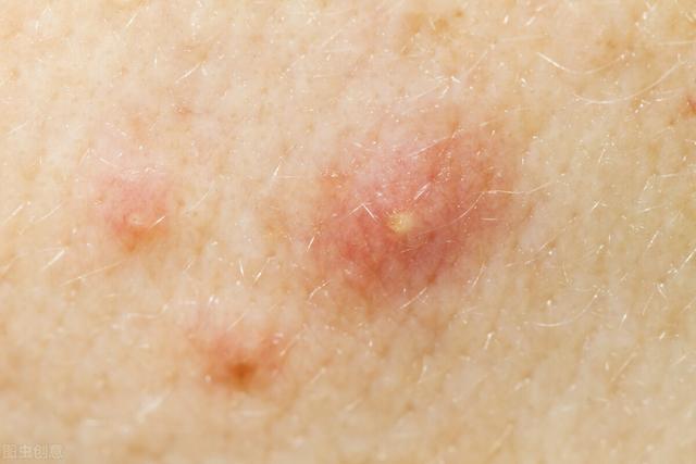 脸上长痘真的与对应的内脏健康有关系吗？