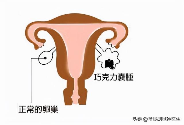 什么是巧克力囊肿？巧克力囊肿可以做试管婴儿吗？
